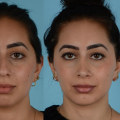 The Truth About Rhinoplasty: What to Expect and How to Choose the Right Surgeon