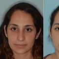 The Secret to Long-Lasting Rhinoplasty Results