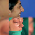 Your Journey To A Perfect Nose With The Top Rhinoplasty Surgeon In Beverly Hills CA